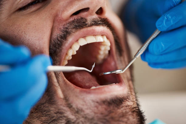 Best Emergency Tooth Extraction in Cameron, TX
